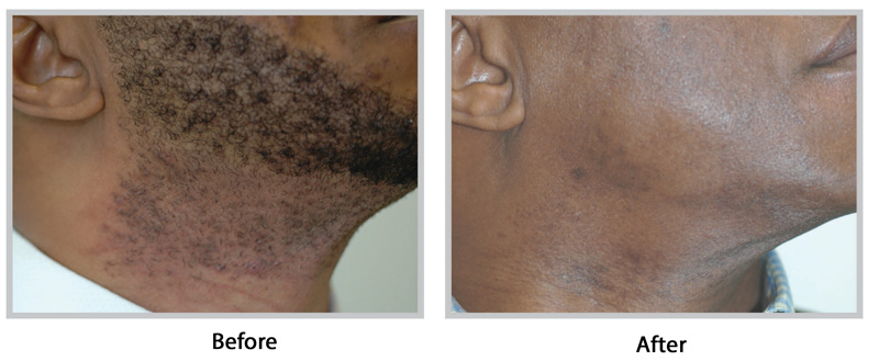 Before and after Folliculitis treatment