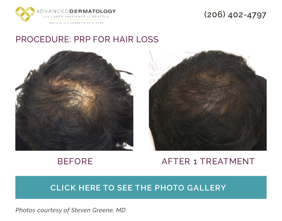 hair restoration with PRP before and after photo