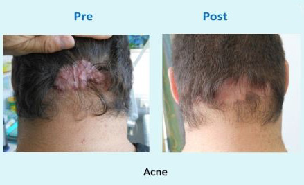 Acne before and after