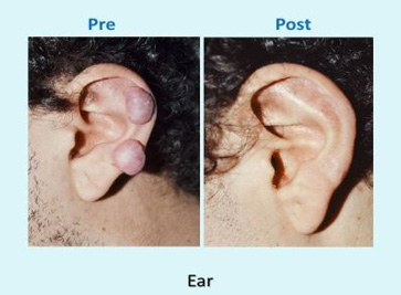 Ear Keloids before and after