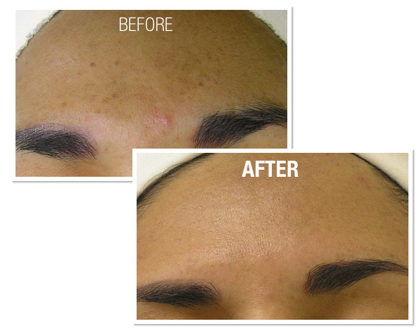 patient with darker skin tone’s forehead before and after HydraFacial treatment, skin smoother and spots and pimple gone after