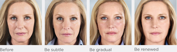 Sculptra before and after photos