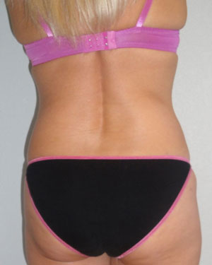 Fat Contouring after photo