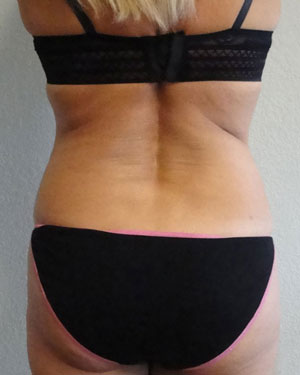 Fat Contouring before photo