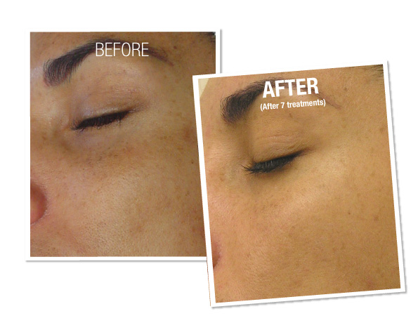 close up of female patient’s cheek before and after HydraFacial treatment, skin rejuvenated after