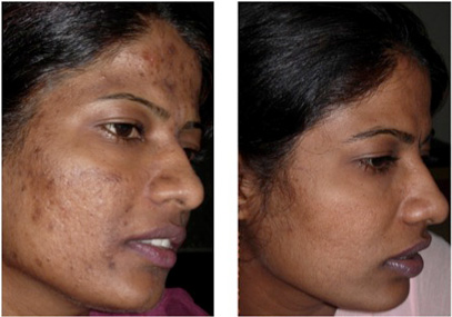 Treatment for Dark Spots Before and After