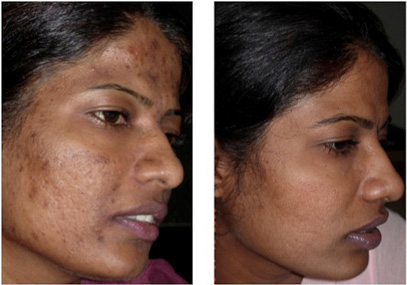 woman with dark skin tone before and after dark spot treatment, spots vanished afterwards