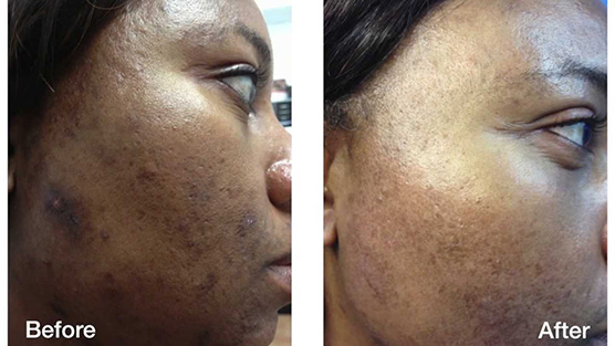 woman with dark skin's cheek before and after dark spot removal, large spot gone after treatment