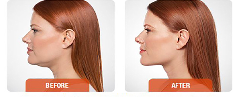 Kybella® Double Chin Treatment - before and after