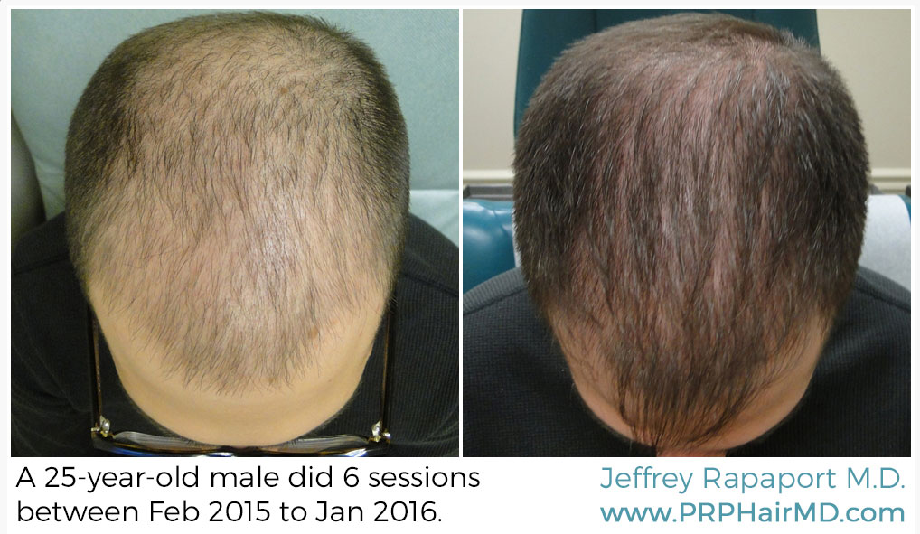 6 sessions of hair restoration with prp