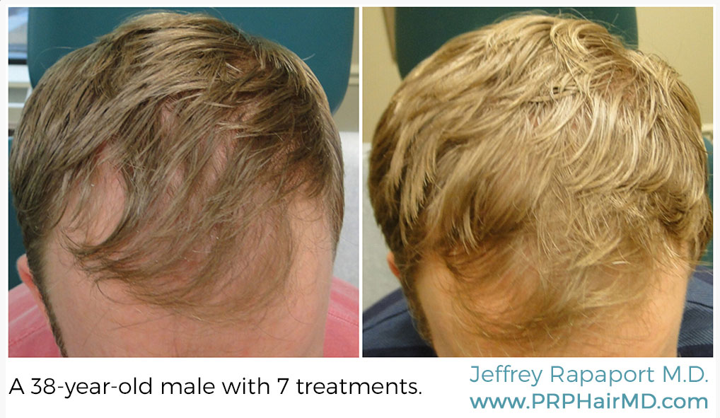 7 treatments of hair restoration with prp