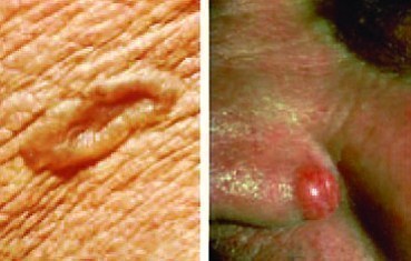 Photo of different Skin Cancers