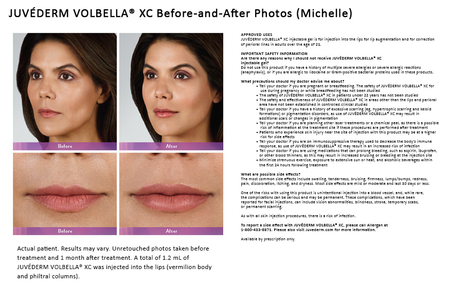 Juvéderm Volbella® Lip Fillers Before & After Photo
