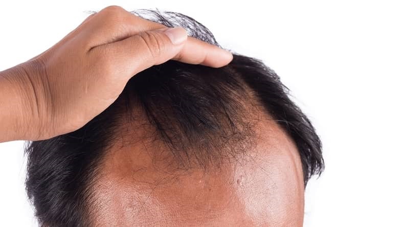 Man with hair loss