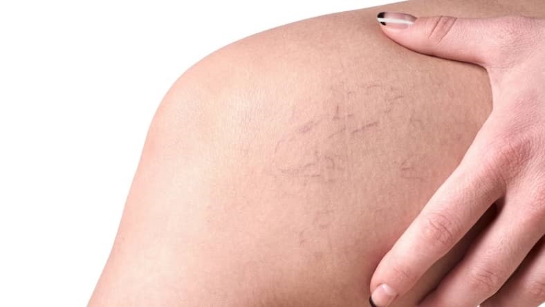 Close up of a woman touching her inner knee to indicate spider veins