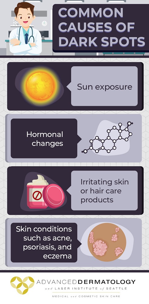 Common causes of dark spots