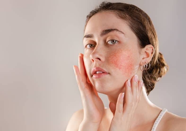 A young woman with rosacea holds her hands up to her face and looks at the camera