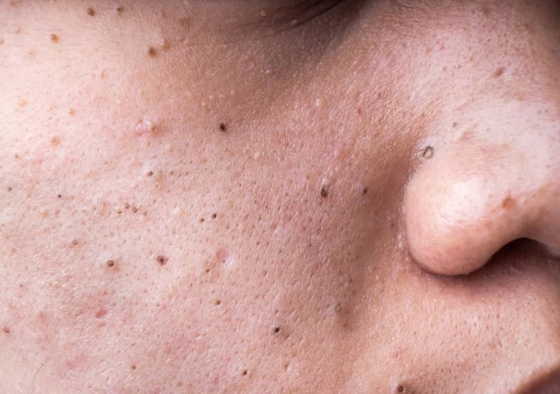 A close up of a man's face with blackheads around the nose and cheek