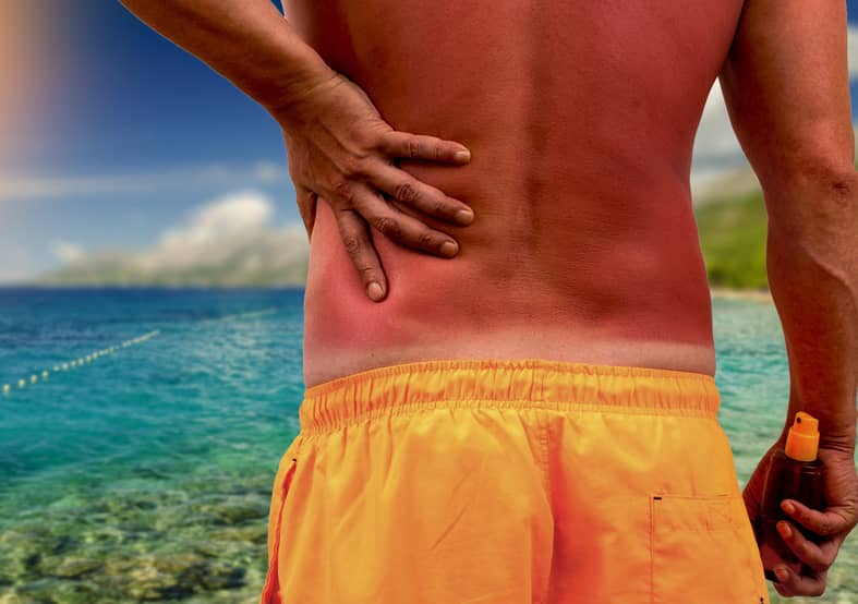 Close up of a man's sunburned back on the beach