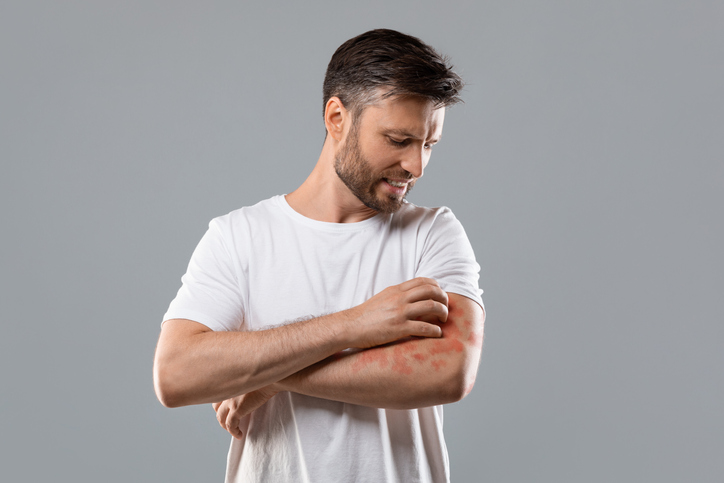 Annoyed man scratching itchy psoriasis rash on his arm