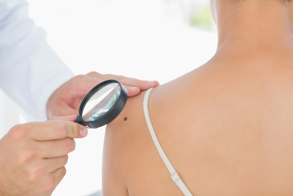 A close up of a woman with a dark mole on her shoulder and a doctor's hand holding a magnifying glass to examine the mole