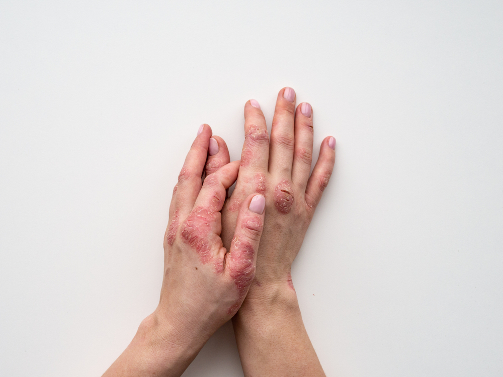 A close up of a woman's hands rubbing together and psoriasis scaley patches are apparent