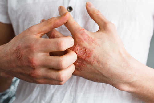 man scratching at eczema dermatitis on hands