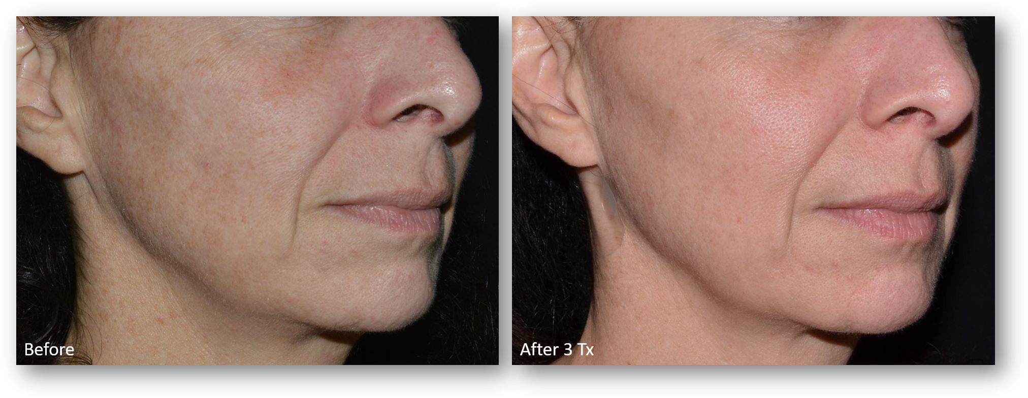 A before and after image of a woman treated by Dr. Greene with LaseMD Ultra