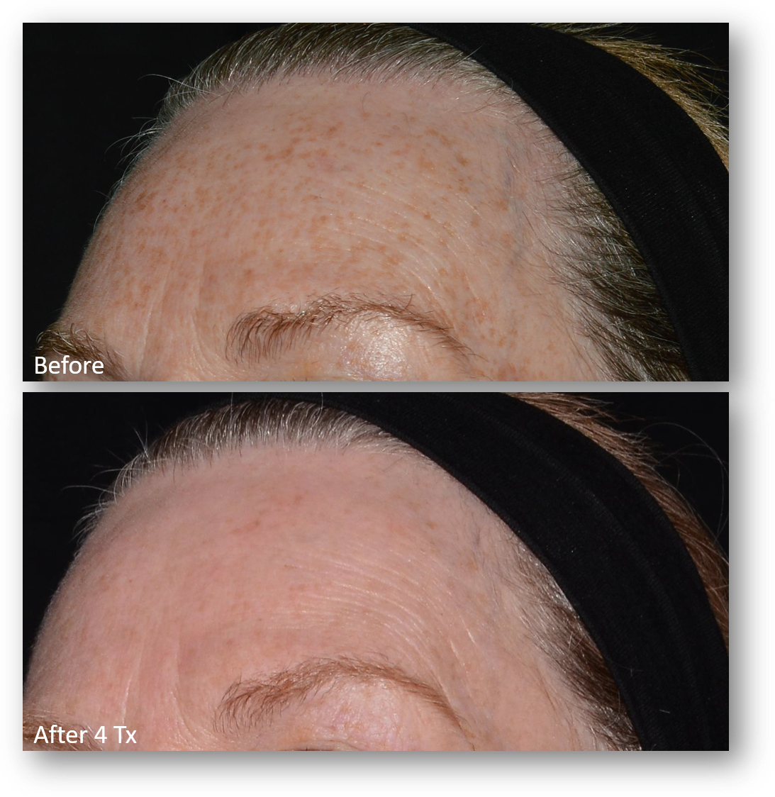 LaseMD Ultra Forehead Before and After