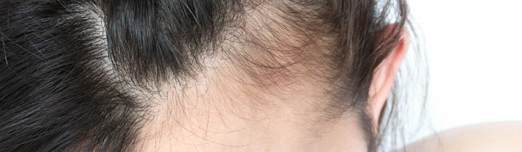 Keralase Treatment for Hair Loss Seattle, Washington | Advanced Dermatology  and Laser Institute of Seattle