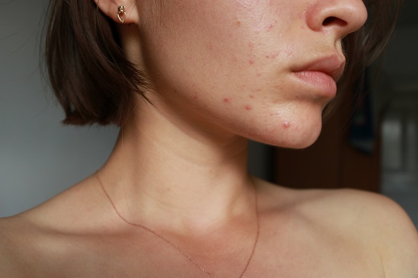 Acne,Problem.,Pimple,Over,The,Lip.,Focus,On,Pimples.,Cometology.