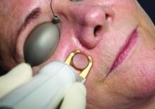 Excel V laser treatment for rosacea